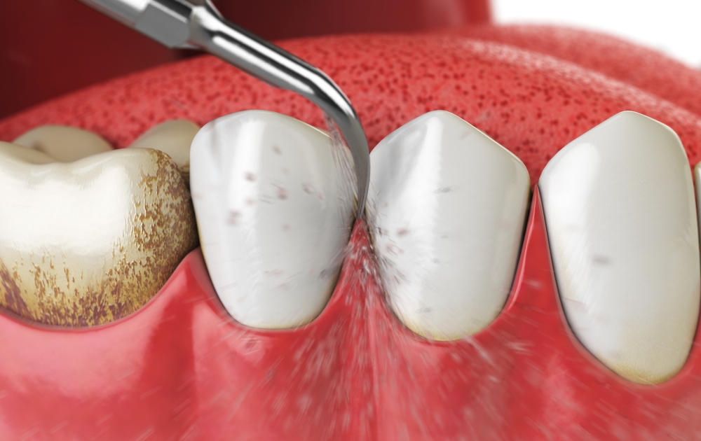 何度も虫歯を作りたくない方へ