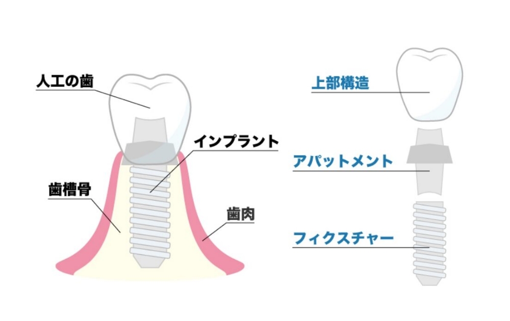 インプラントとは？