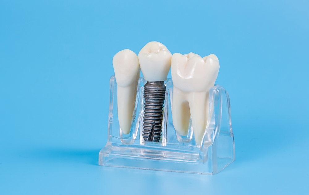 入れ歯やブリッジとの違い