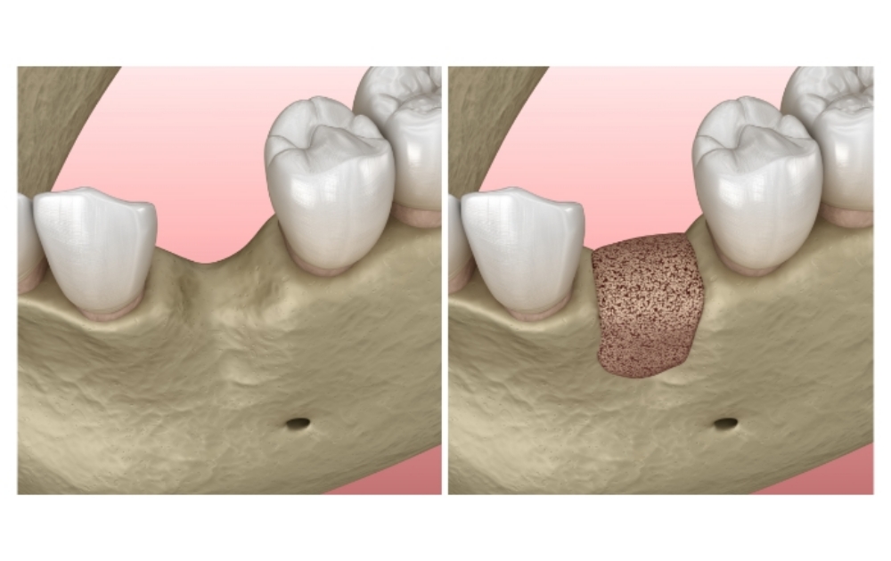 他院でインプラント治療を断られた方へ