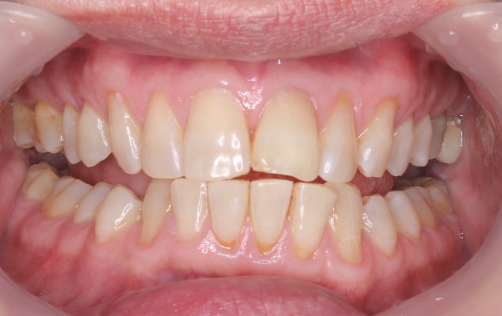 インターナルブリーチ後