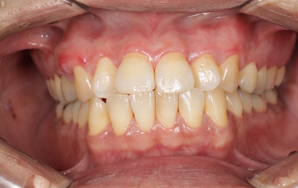 ガムピーリング後